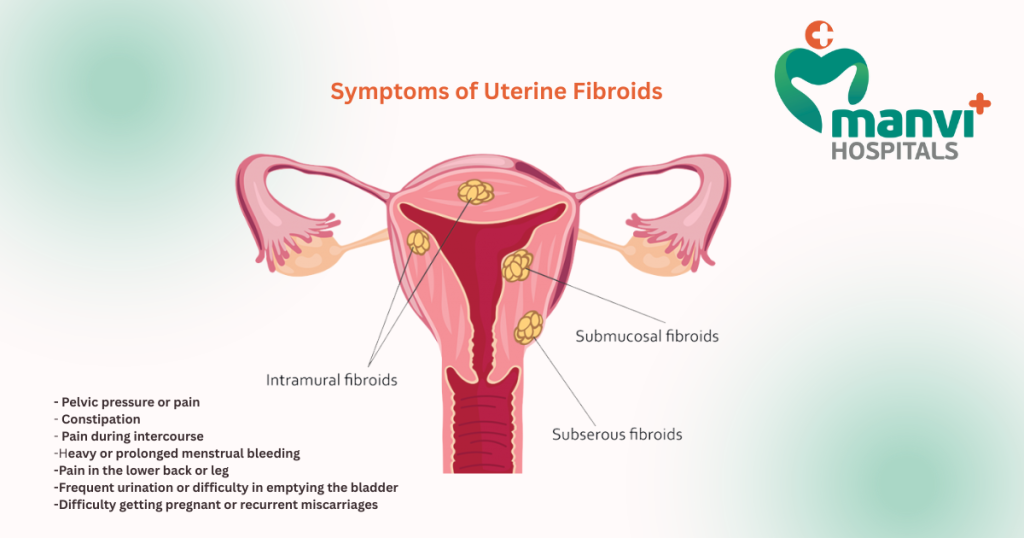 Uterine Fibroids