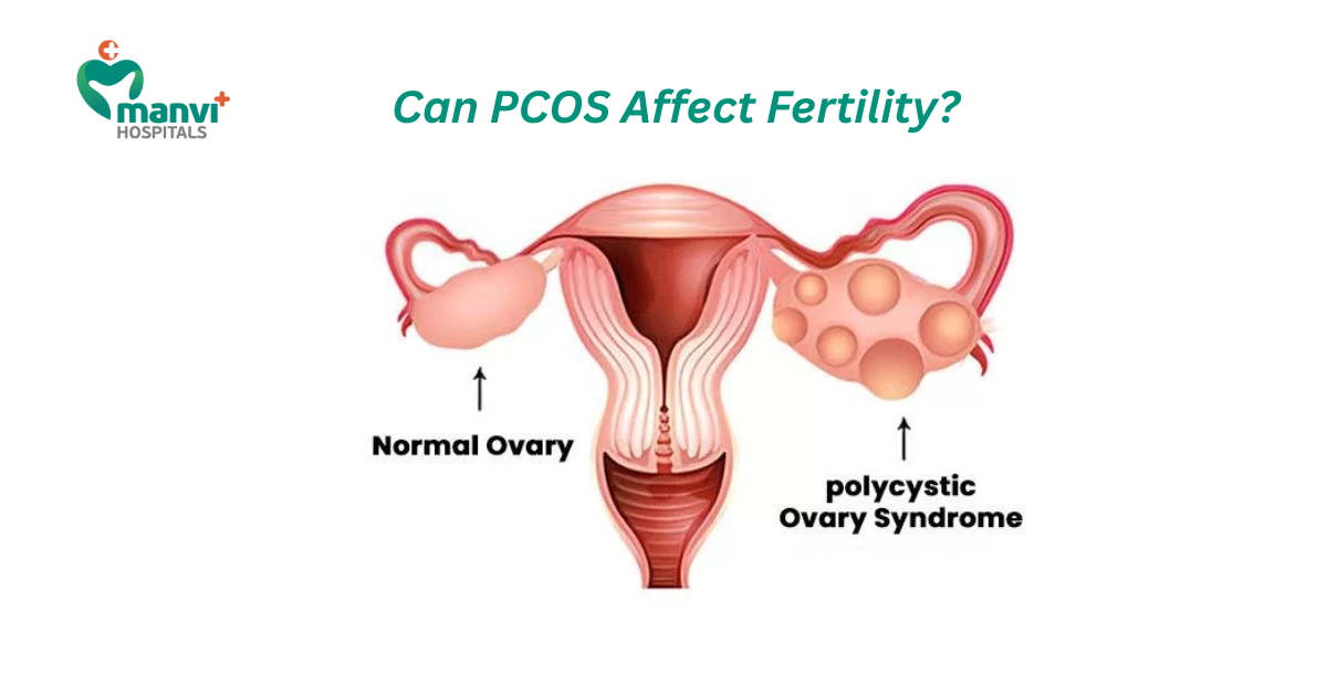 Can PCOS Affect Fertility? Understanding the Connection and Available Treatments